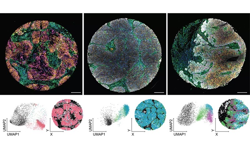 Imagen: La nueva técnica permite que las propiedades de las células cancerosas y su tejido circundante se analicen en detalle a nivel de células individuales (Foto cortesía de Universität Helsinki/Karolina Punovuori)